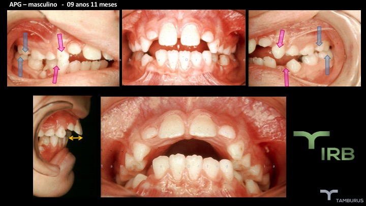 Caso 01 - IRB Ortodontia