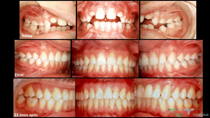 Caso 01 - IRB Ortodontia