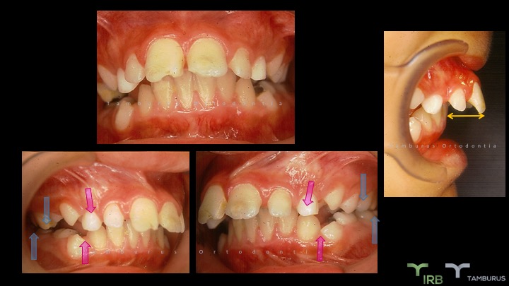 Caso 03 - IRB Ortodontia