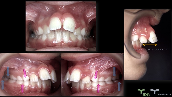 Caso 04 - IRB Ortodontia