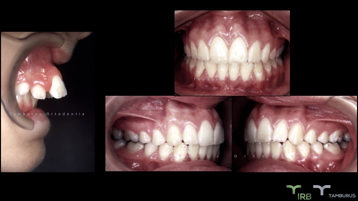 Caso 04 - IRB Ortodontia