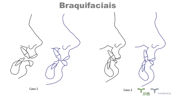 Caso 04 - IRB Ortodontia