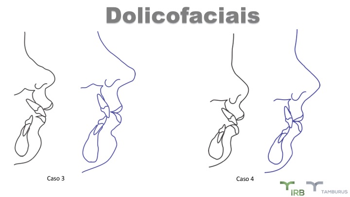 Caso 04 - IRB Ortodontia