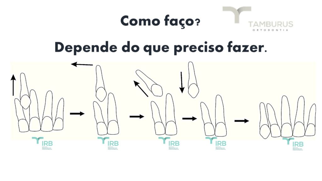 Caso 6 - Transposição Completa IRB