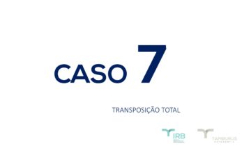 Caso 7 - Transposição Total IRB