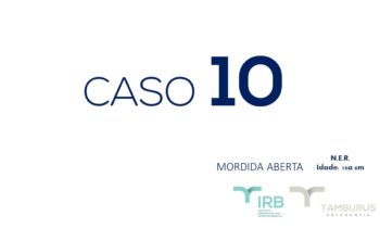 Caso 10 - Mordida Aberta - IRB