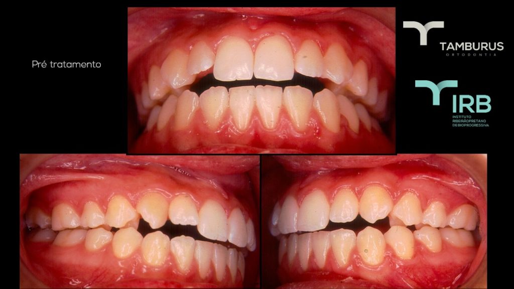 Caso 10 - Mordida Aberta - IRB