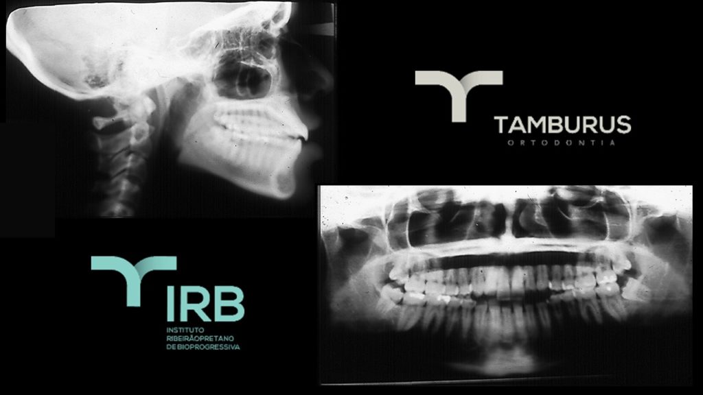 Caso 10 - Mordida Aberta - IRB