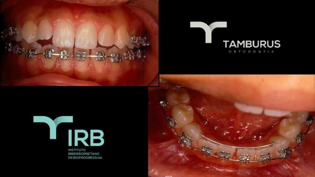 Caso 10 - Mordida Aberta - IRB
