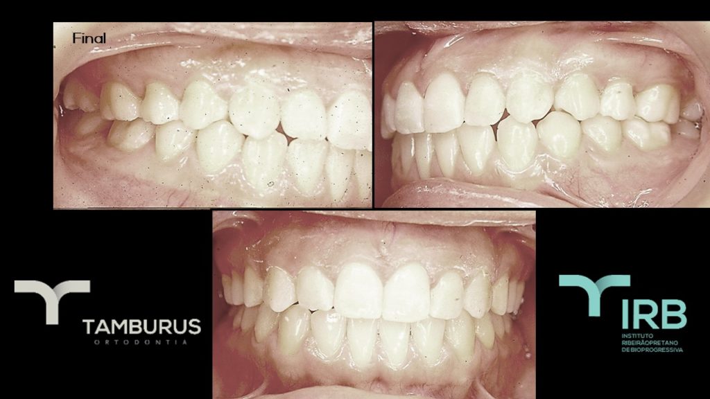 Caso 10 - Mordida Aberta - IRB