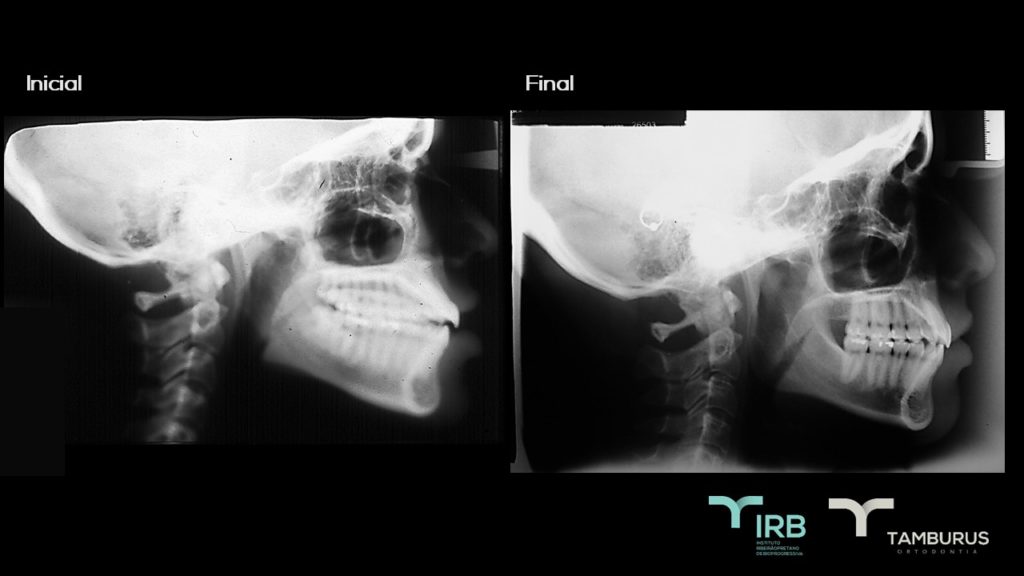 Caso 10 - Mordida Aberta - IRB