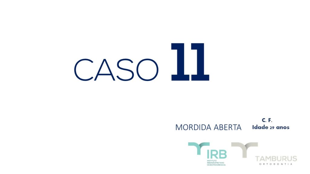 Caso 11 - Mordida Aberta - IRB