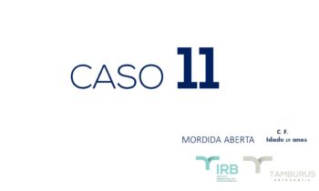 Caso 11 - Mordida Aberta - IRB