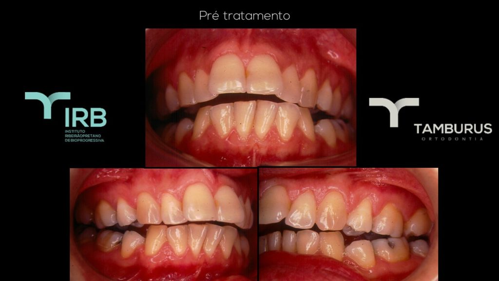 Caso 11 - Mordida Aberta - IRB