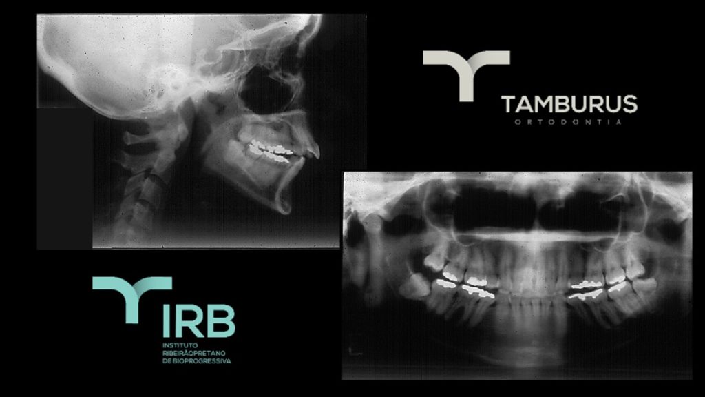 Caso 11 - Mordida Aberta - IRB