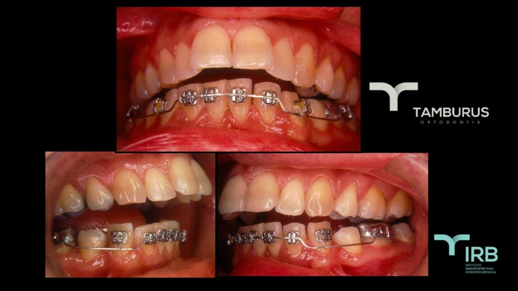 Caso 11 - Mordida Aberta - IRB