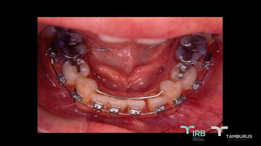 Caso 11 - Mordida Aberta - IRB