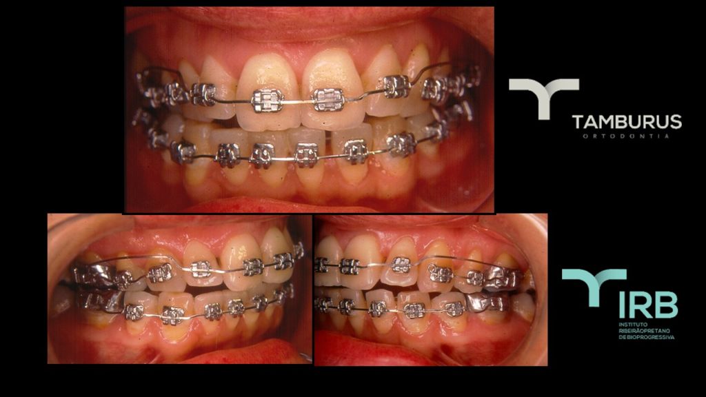 Caso 11 - Mordida Aberta - IRB