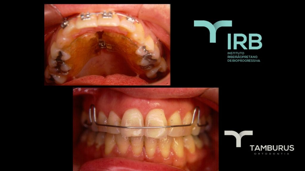 Caso 11 - Mordida Aberta - IRB