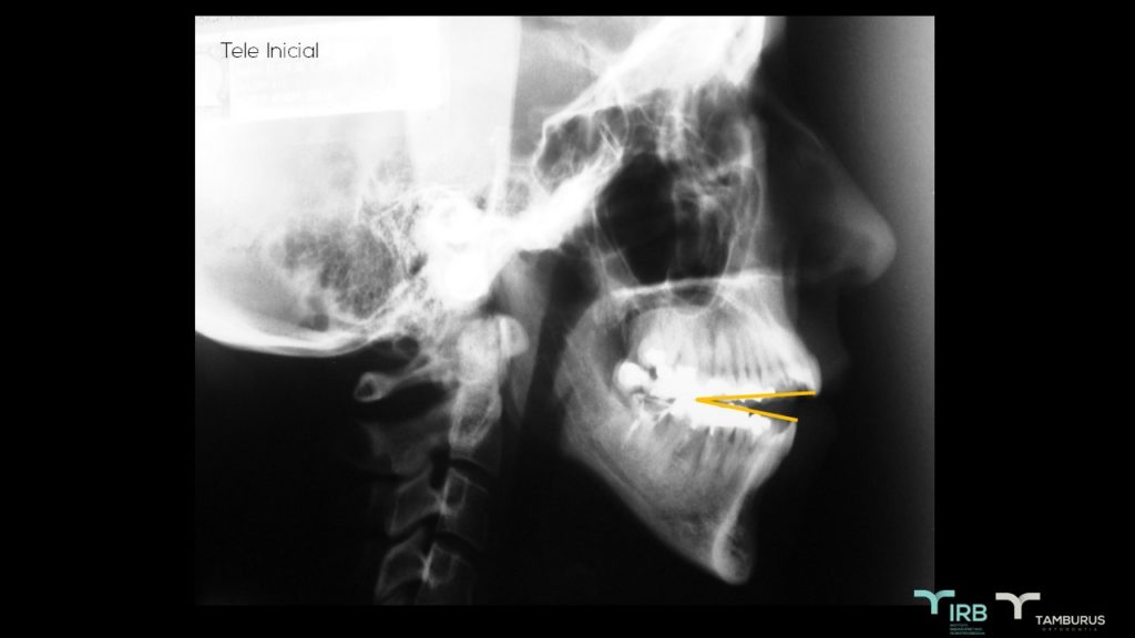Caso 9 - Mordida Aberta - IRB