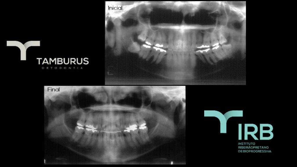 Caso 11 - Mordida Aberta - IRB