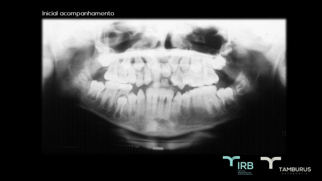 Caso 12 - Mordida Aberta - IRB