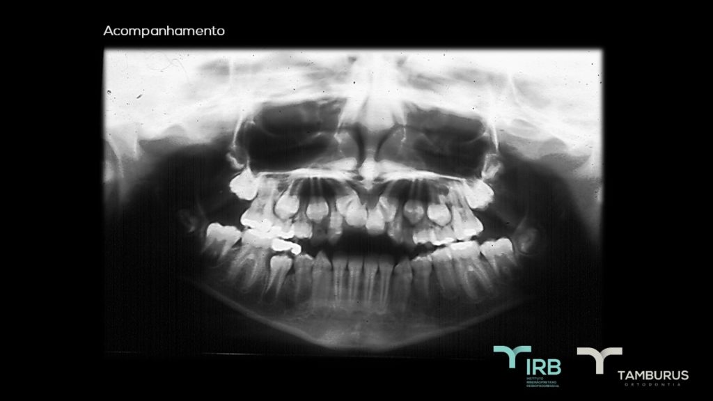 Caso 12 - Mordida Aberta - IRB