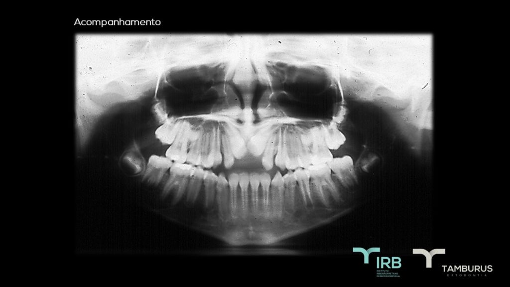 Caso 12 - Mordida Aberta - IRB