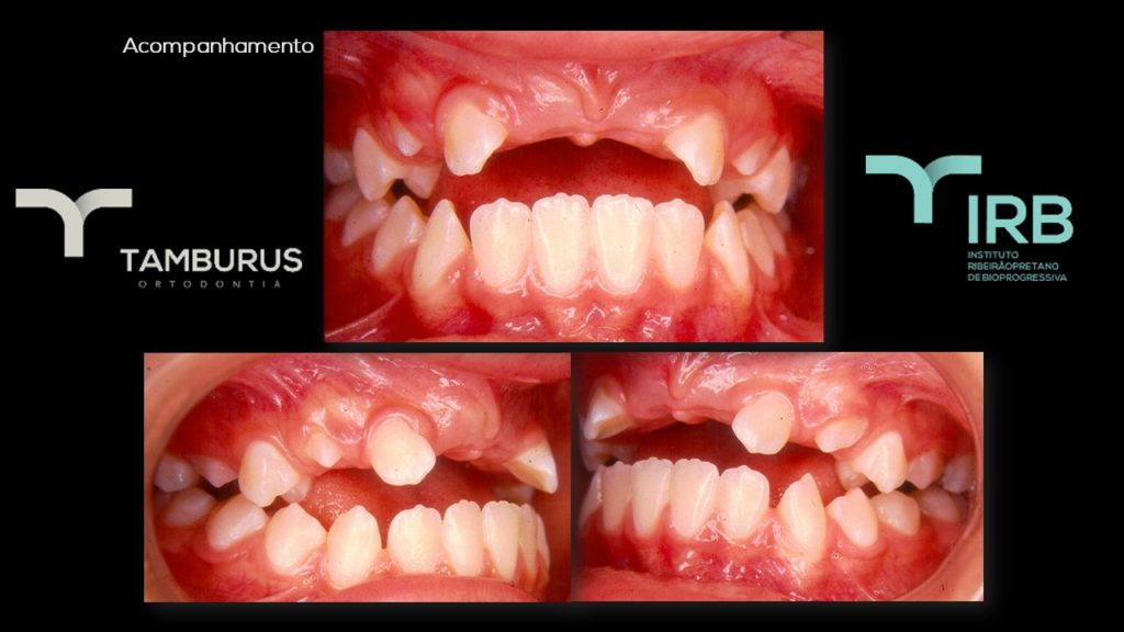 Caso 12 - Mordida Aberta - IRB