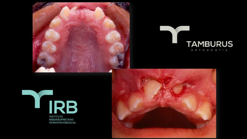 Caso 12 - Mordida Aberta - IRB