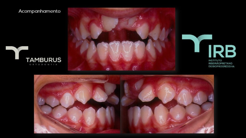 Caso 12 - Mordida Aberta - IRB