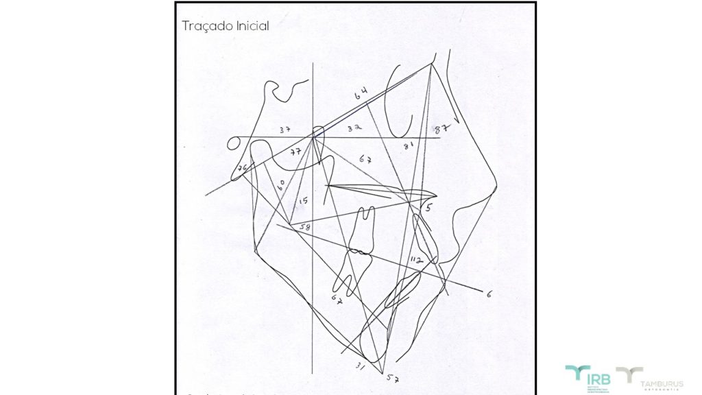 Caso 9 - Mordida Aberta - IRB