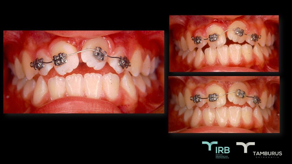 Caso 12 - Mordida Aberta - IRB
