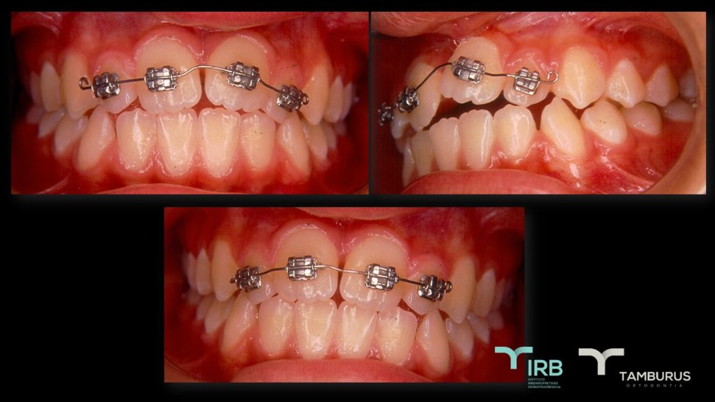 Caso 12 - Mordida Aberta - IRB