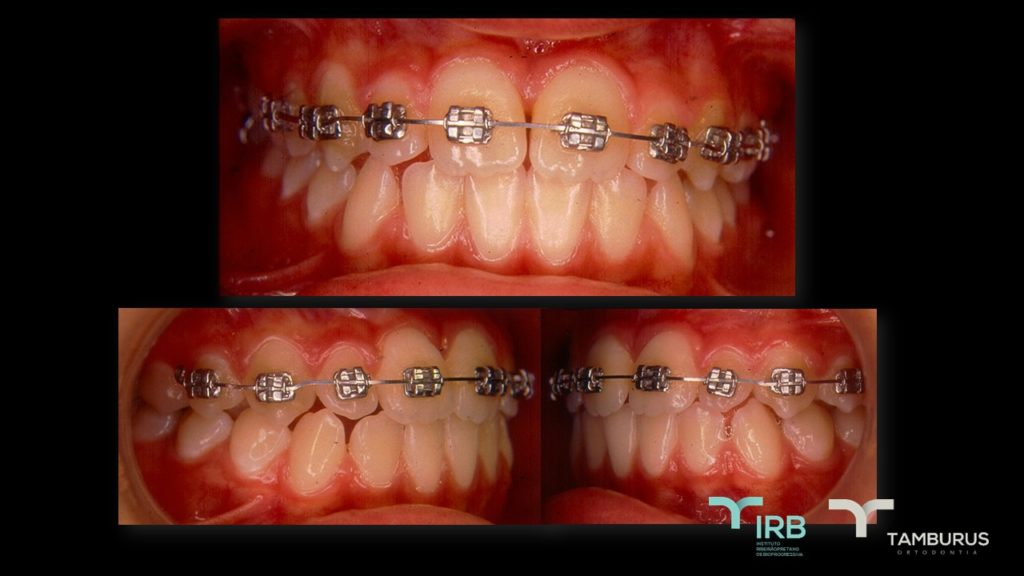 Caso 12 - Mordida Aberta - IRB