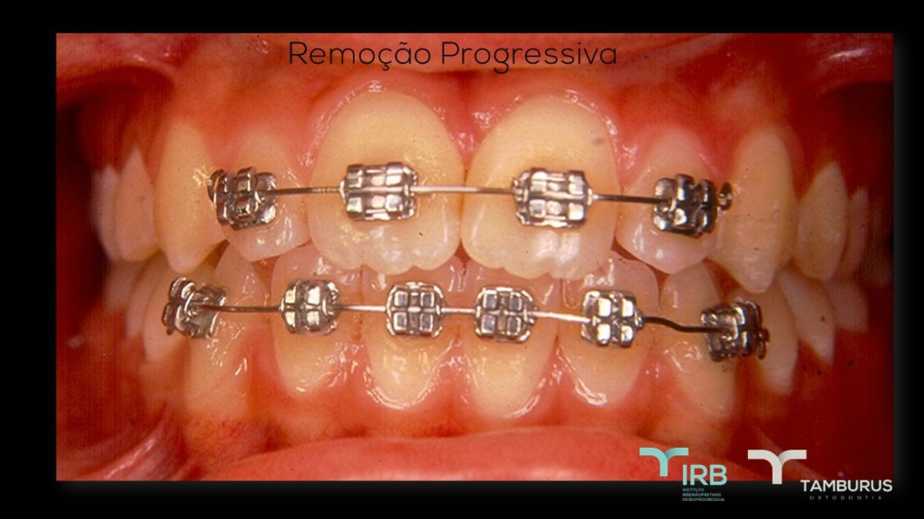 Caso 12 - Mordida Aberta - IRB