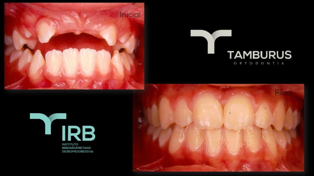 Caso 12 - Mordida Aberta - IRB