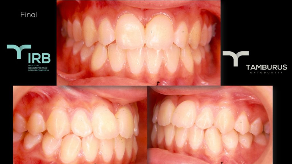 Caso 12 - Mordida Aberta - IRB