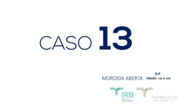 Caso 13 - Mordida Aberta - IRB