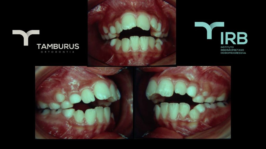 Caso 13 - Mordida Aberta - IRB