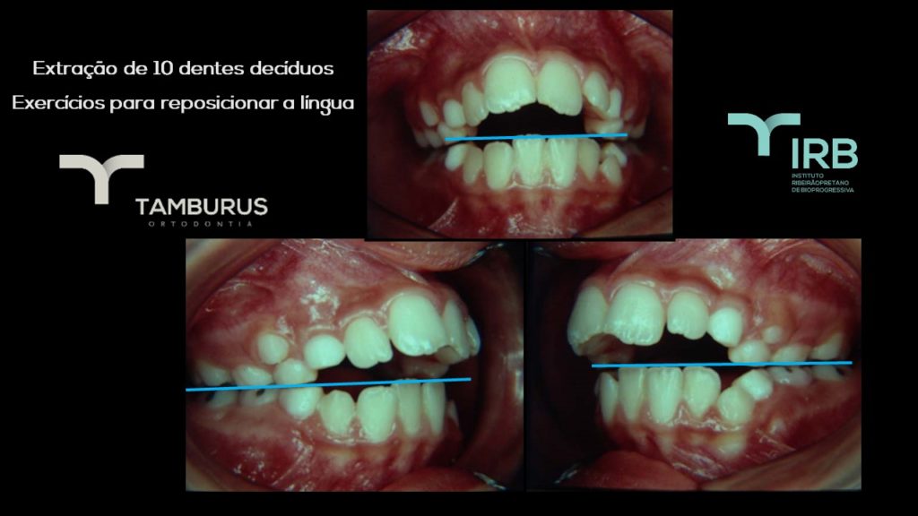 Caso 13 - Mordida Aberta - IRB