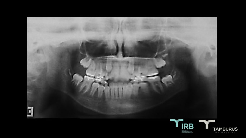 Caso 13 - Mordida Aberta - IRB