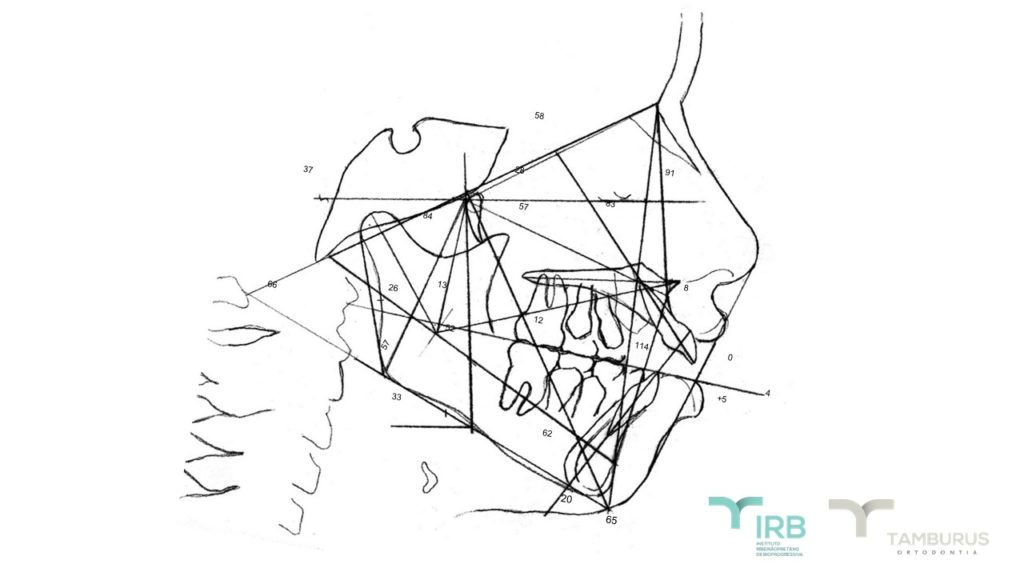 Caso 13 - Mordida Aberta - IRB