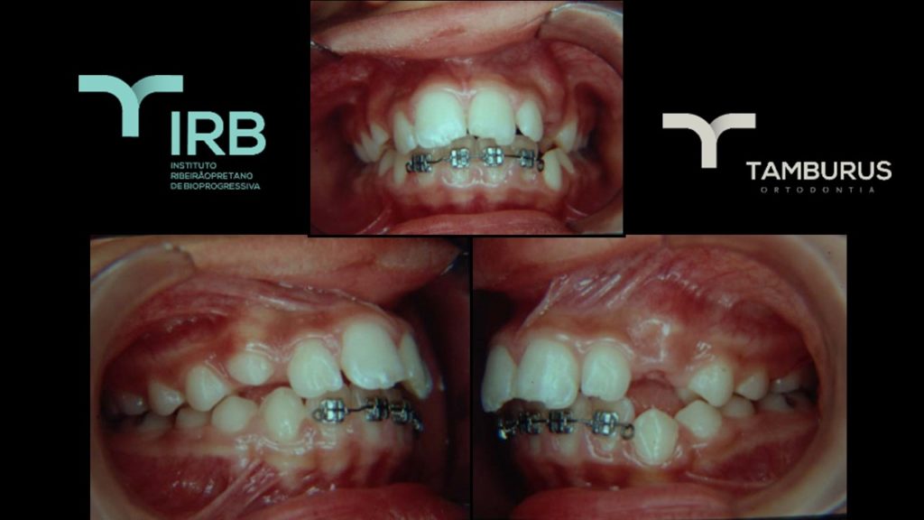 Caso 13 - Mordida Aberta - IRB