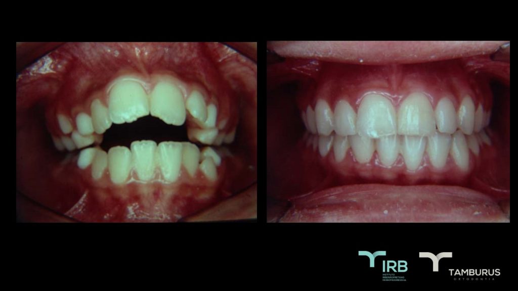 Caso 13 - Mordida Aberta - IRB